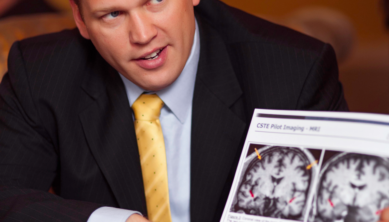 Christopher Nowinski presents neuropathological data illustrating the progression of Chronic Traumatic Encephalopathy (CTE) pathology and tau protein accumulation in brain tissue. His research visualizations, developed through Concussion Legacy Foundation’s Brain Bank at Boston University, demonstrate how repeated head impacts lead to brain deterioration. These findings directly inform policy changes across the NFL, NHL, NCAA, and youth sports organizations.